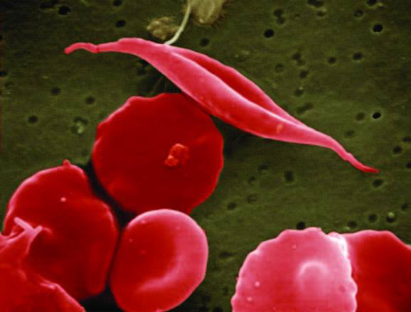 Sickle Cell Disease